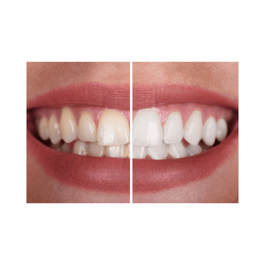 The Truth about Repairing and Strengthening Tooth Enamel - sheeralternatives