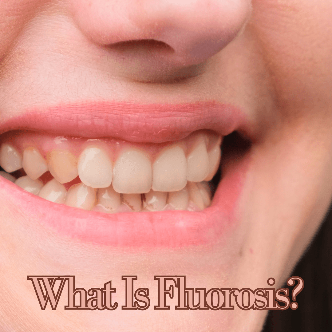 The Definitive Guide to Fluorosis